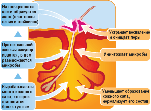 Элоком лосьон прыщи на лице